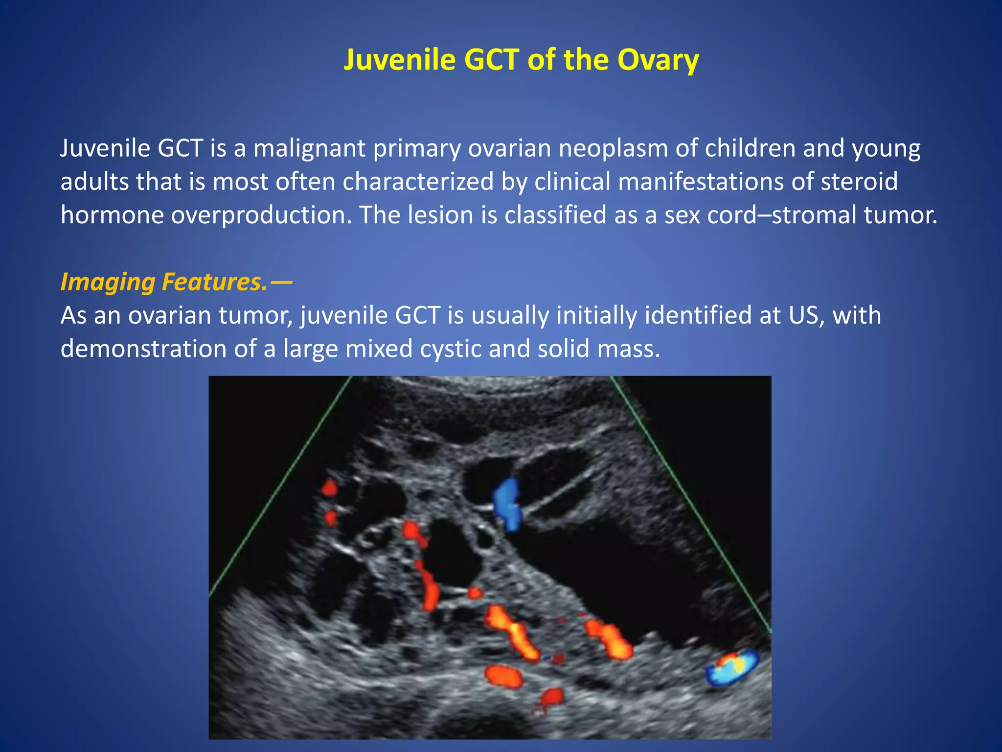 Juvenile GCT of the Ovary
Juvenile GCT is a malignant primary ovarian neoplasm of children and young
adults that is most often characterized by clinical manifestations of steroid
hormone overproduction. The lesion is classified as a sex cord–stromal tumor.
Imaging Features.—
As an ovarian tumor, juvenile GCT is usually initially identified at US, with
demonstration of a large mixed cystic and solid mass.
 