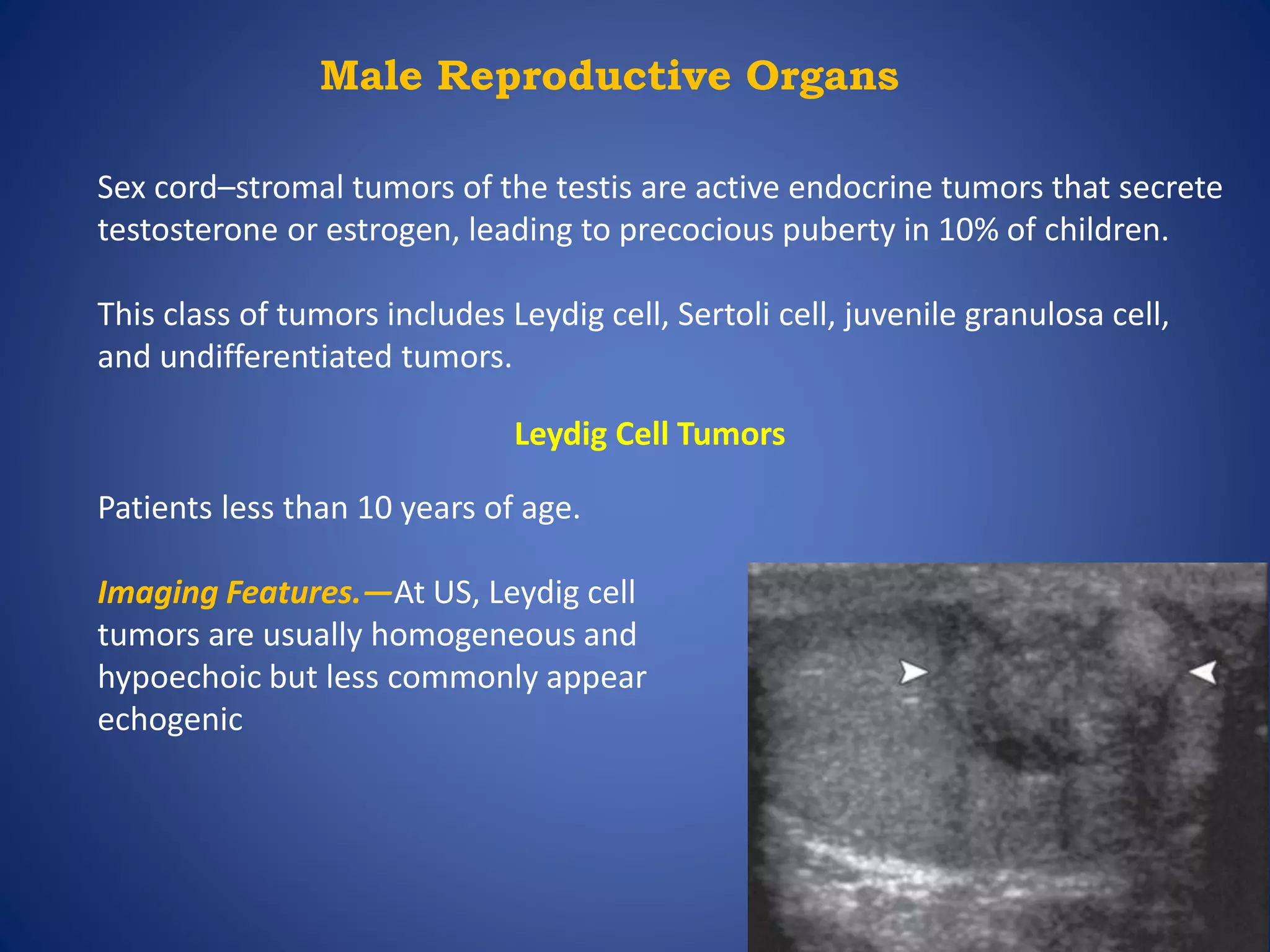 Male Reproductive Organs
Sex cord–stromal tumors of the testis are active endocrine tumors that secrete
testosterone or estrogen, leading to precocious puberty in 10% of children.
This class of tumors includes Leydig cell, Sertoli cell, juvenile granulosa cell,
and undifferentiated tumors.
Leydig Cell Tumors
Patients less than 10 years of age.
Imaging Features.—At US, Leydig cell
tumors are usually homogeneous and
hypoechoic but less commonly appear
echogenic
 