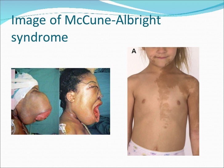 Precocious Puberty Ppt. precocious puberty precocious puberty ppt. 