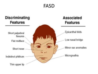 FASD
 