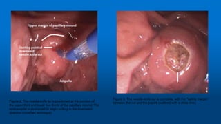 Figure 2. The needle-knife tip is positioned at the junction of
the upper third and lower two thirds of the papillary mound. The
endoscopist is positioned to begin cutting in the downward
direction (modified technique).
Figure 3. The needle-knife cut is complete, with the ‘‘safety margin’’
between the cut and the papilla (outlined with a white line).
Early institution of pre-cutting for difficult biliary cannulation:a prospective study comparing conventional vs. a modified technique
 