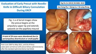 Evaluation of Early Precut with Needle-
Knife in Difficult Biliary Cannulation
During ERCP
Dig Dis Sci (2013) 58:3606–3610
Jian-hong Zhu • Qiang Liu • De-qing Zhang
Fig. 1 a–d Serial images show
the precut begins at the
ampullary upper lip and extends
upwards on the papillary mound
A total of 24 cases were abandoned due to
periampullary diverticulum or small papilla
from June 2007 to May 2011, and 56 of these
cases were carried out with precut biliary sphincterotomy
after the standard sphincterotomy had failed
 