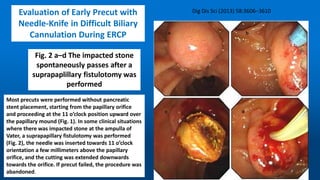 Fig. 2 a–d The impacted stone
spontaneously passes after a
suprapaplillary fistulotomy was
performed
Evaluation of Early Precut with
Needle-Knife in Difficult Biliary
Cannulation During ERCP
Most precuts were performed without pancreatic
stent placement, starting from the papillary orifice
and proceeding at the 11 o’clock position upward over
the papillary mound (Fig. 1). In some clinical situations
where there was impacted stone at the ampulla of
Vater, a suprapapillary fistulotomy was performed
(Fig. 2), the needle was inserted towards 11 o’clock
orientation a few millimeters above the papillary
orifice, and the cutting was extended downwards
towards the orifice. If precut failed, the procedure was
abandoned.
 