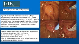 Figure 1. Needle-knife fistulotomy technique. A, Major
duodenal papilla; B, small mucosal incision using a needle-
knife papillotome is performed in the 11 to 12 o’clock position
on the top of the infundibulum, avoiding touching the orifice;
C, sphincter of Oddi muscle of the bile duct is visible after the
incision; D, biliary cannulation is achieved by pricking the
stigma with a needle-knife.
Seven of the 62 patients were excluded due to periampullary
diverticulum (PAD) type I (n Z 1) or II (n Z 4),
stone located at the papilla orifice (n Z 1), and
choledochoduodenal fistula (n Z 1).
Thus, 55 patients were enrolled in this prospective study, all
of whom underwent ERCP and NKF.
 