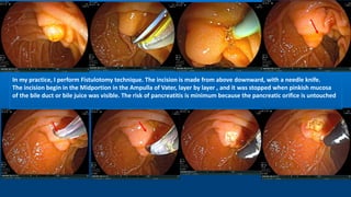 In my practice, I perform Fistulotomy technique. The incision is made from above downward, with a needle knife.
The incision begin in the Midportion in the Ampulla of Vater, layer by layer , and it was stopped when pinkish mucosa
of the bile duct or bile juice was visible. The risk of pancreatitis is minimum because the pancreatic orifice is untouched
 