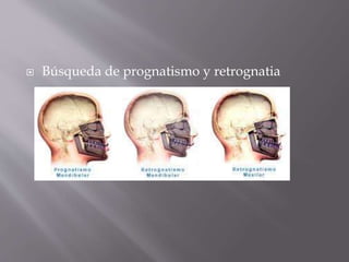  Búsqueda de prognatismo y retrognatia
 