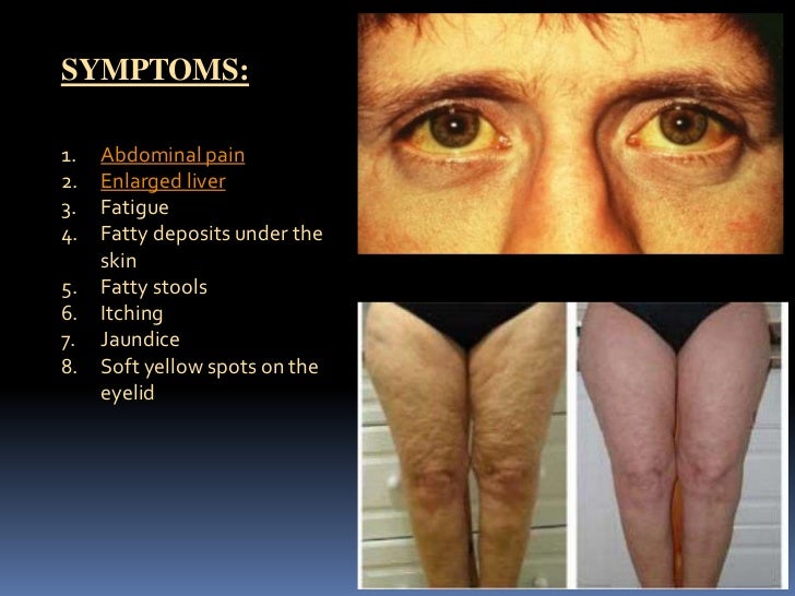 Liver Mediated Diseases And Viral Hepatitis Hepatitis yellow eyes and skin,Liver Mediated Diseases And Viral Hepatitis