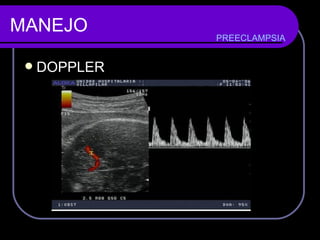 MANEJO DOPPLER  PREECLAMPSIA 
