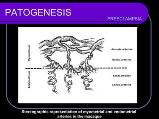 PATOGENESIS PREECLAMPSIA Stereographic representation of myometrial and endometrial  arteries in the macaque 