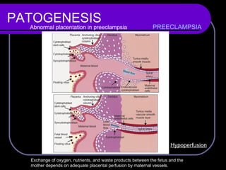 PATOGENESIS PREECLAMPSIA Exchange of oxygen, nutrients, and waste products between the fetus and the  mother depends on adequate placental perfusion by maternal vessels.  Abnormal placentation in preeclampsia  Hypoperfusion 