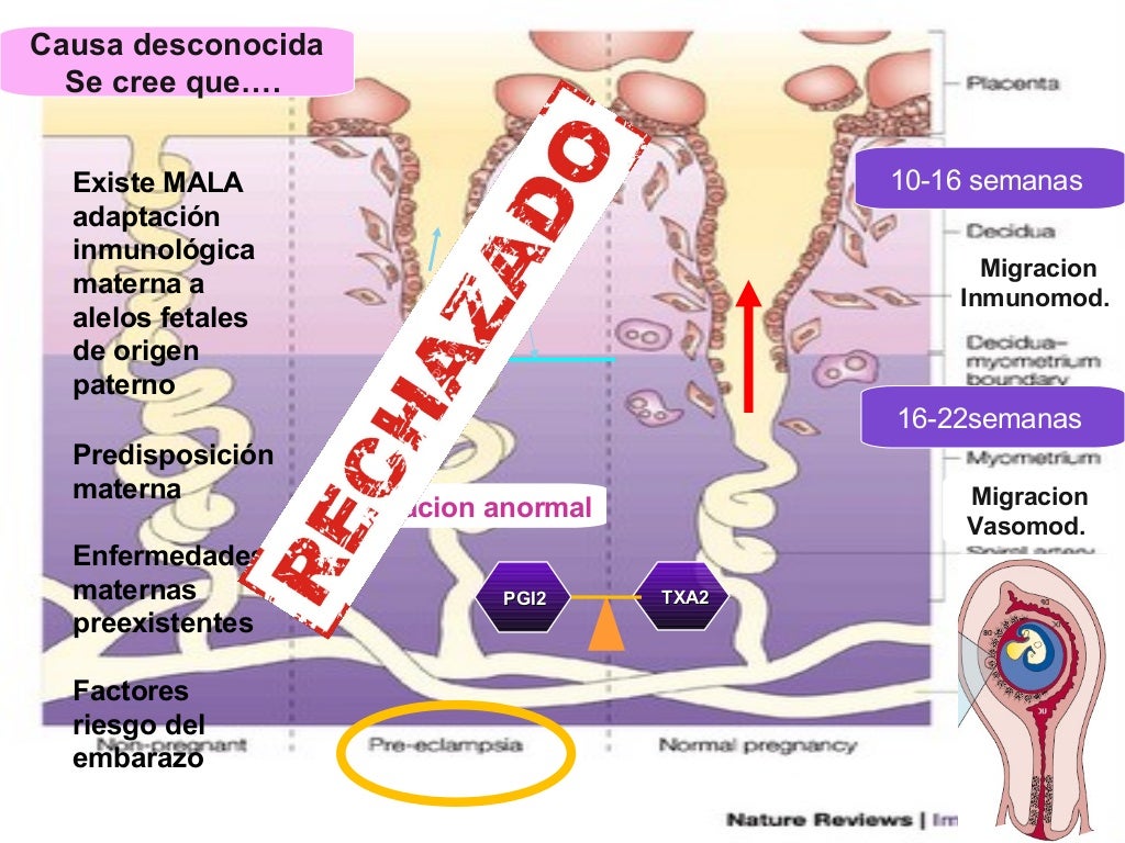 Preeclampsia hellp 2015