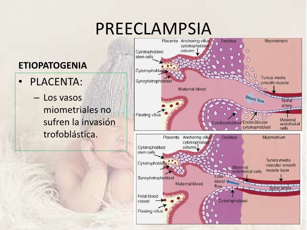 Preeclampsia, eclampsia y s. hellp