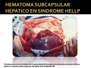 Preeclampsia guía perinatal colombiana. Guía 14, guia de atención de las complicaciones hipertensivas asociadas al embarazo
Obstetrics, normal and problem pregnancies, sixth edition. Steven G Gabbe MD. 2012

 
