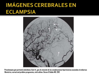 Preeclampsia guía perinatal colombiana. Guía 14, guia de atención de las complicaciones hipertensivas asociadas al embarazo
Obstetrics, normal and problem pregnancies, sixth edition. Steven G Gabbe MD. 2012

 
