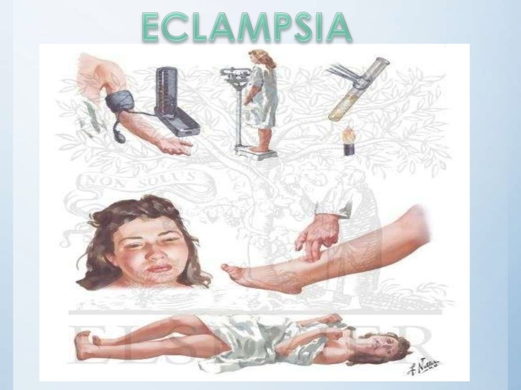 Preeclampsia y eclampsia