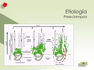 Etiología

Preeclampsia

 