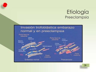 Etiología

Preeclampsia

 