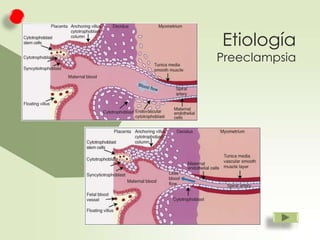 Etiología

Preeclampsia

 