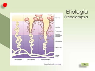 Etiología

Preeclampsia

 