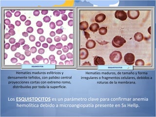 Hematíes maduros, de tamaño y forma
irregulares o fragmentos celulares, debidos a
roturas de la membrana.
Hematíes maduros esféricos y
densamente teñidos, con palidez central
proyecciones cortas con extremo romo,
distribuidas por toda la superficie.
Los ESQUISTOCITOS es un parámetro clave para confirmar anemia
hemolítica debido a microangiopatía presente en Sx Hellp.
 