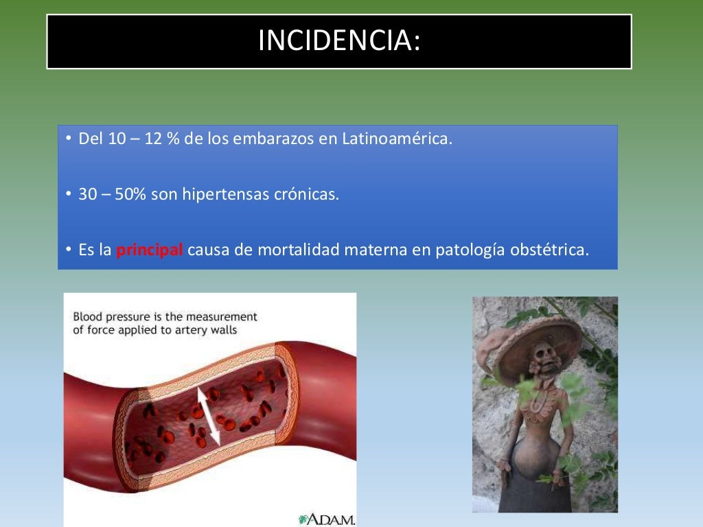 Preeclámpsia Toxemia GravídicaElza Herminia Sabino Mendes e Thiago