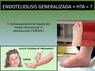ENDOTELIOLISIS GENERALIZADA + HTA = ?
R: Extravasamiento de líquido del
medio intravascular al
extravascular ( EDEMA )
 