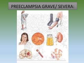 PREECLAMPSIA GRAVE/ SEVERA:
 