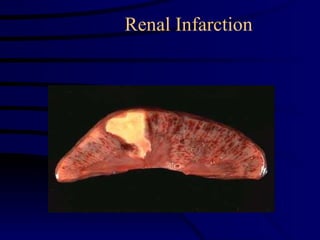 Renal Infarction 
