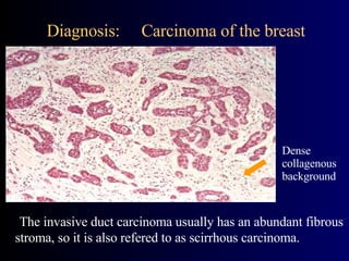 Diagnosis:  Carcinoma of the breast The invasive duct carcinoma usually has an abundant fibrous stroma, so it is also refered to as scirrhous carcinoma. Dense collagenous background  
