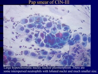 Pap smear of CIN-III Large hyperchromatic nuclei, nuclear pleomorphism .There are  some interspersed neutrophils with lobated nuclei and much smaller size. 