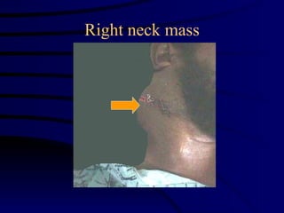 Right neck mass 