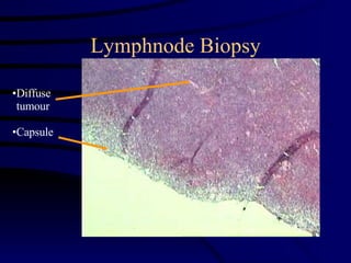 Lymphnode Biopsy Diffuse tumour Capsule 