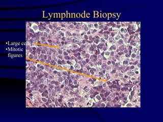 Lymphnode Biopsy Large cells Mitotic figures 