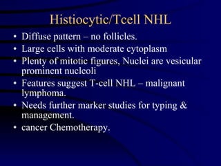 Histiocytic/Tcell NHL Diffuse pattern – no follicles. Large cells with moderate cytoplasm Plenty of mitotic figures, Nuclei are vesicular prominent nucleoli Features suggest T-cell NHL – malignant lymphoma. Needs further marker studies for typing & management. cancer Chemotherapy. 