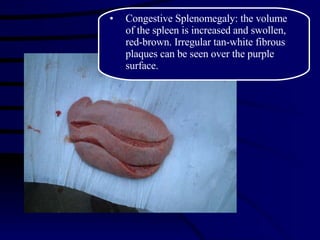 Congestive Splenomegaly: the volume of the spleen is increased and swollen, red-brown. Irregular tan-white fibrous plaques can be seen over the purple surface. 