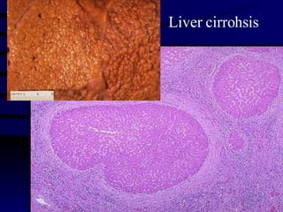 Liver cirrohsis 