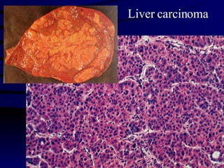 Liver carcinoma 