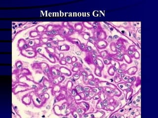 Membranous GN 