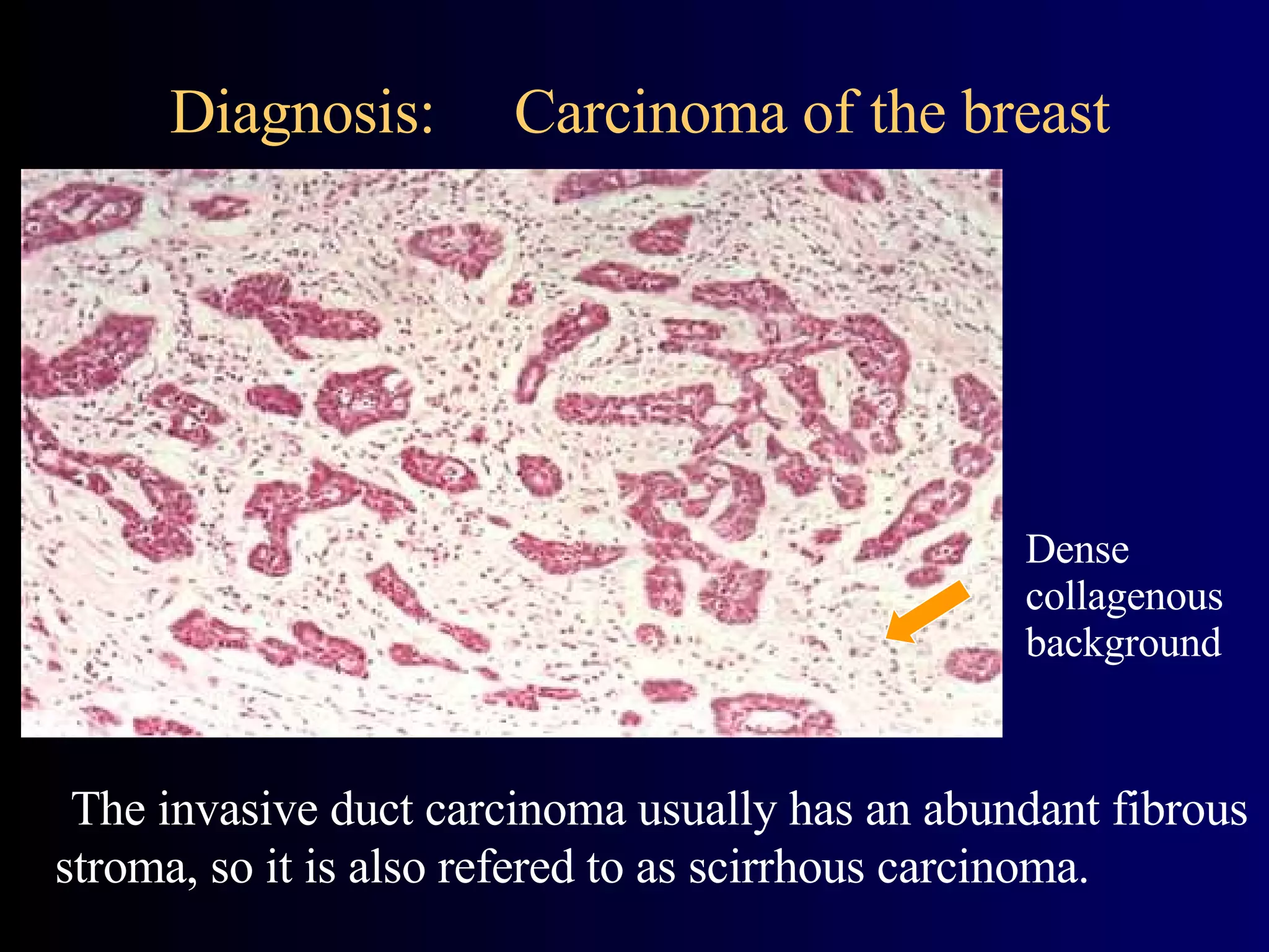 Diagnosis:  Carcinoma of the breast The invasive duct carcinoma usually has an abundant fibrous stroma, so it is also refered to as scirrhous carcinoma. Dense collagenous background  