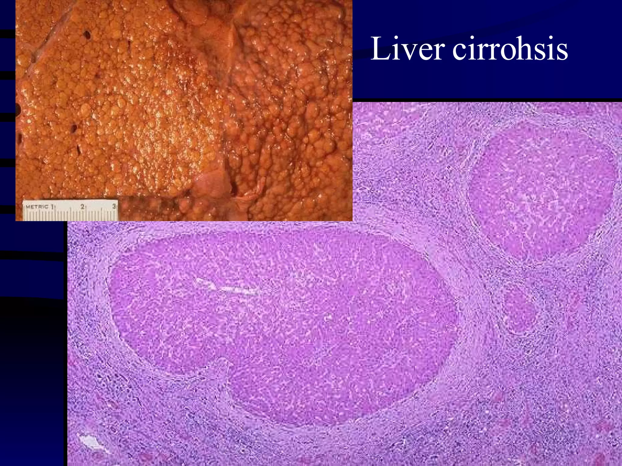 Liver cirrohsis 