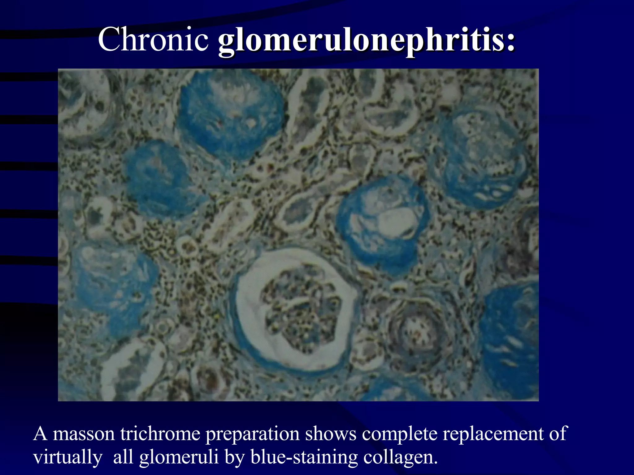 A masson trichrome preparation shows complete replacement of virtually  all glomeruli by blue-staining collagen. Chronic  glomerulonephritis: 