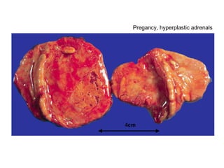 Pregancy, hyperplastic adrenals