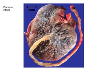 Placenta, infarct
