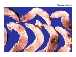 Placenta, infarcts