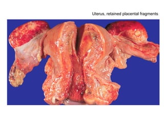 Uterus, retained placental fragments