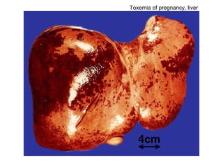 Toxemia of pregnancy, liver