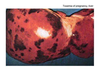 Toxemia of pregnancy, liver