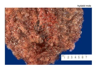 hydatid mole