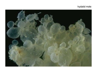 hydatid mole