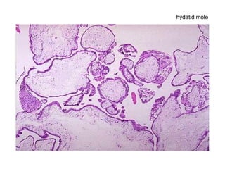 hydatid mole